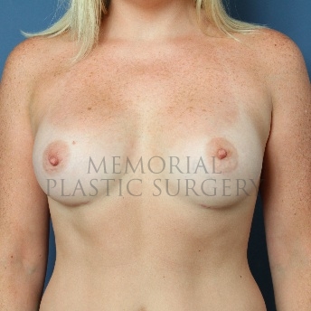 A front view after photo of patient 61 that underwent Breast Augmentation procedures at Memorial Plastic Surgery