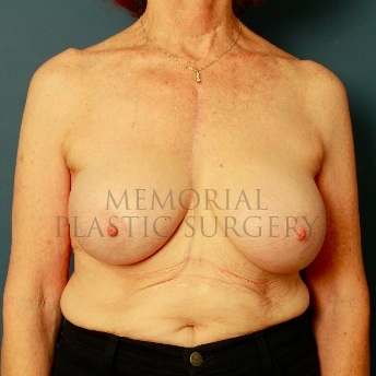 A front view after photo of patient 72 that underwent Breast Augmentation procedures at Memorial Plastic Surgery