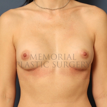 A front view after photo of patient 406 that underwent Breast Augmentation procedures at Memorial Plastic Surgery