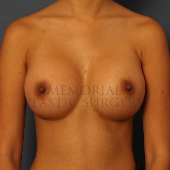 A front view after photo of patient 440 that underwent Breast Augmentation procedures at Memorial Plastic Surgery