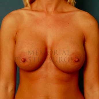 A front view after photo of patient 58 that underwent Breast Augmentation procedures at Memorial Plastic Surgery