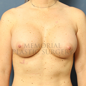 A front view after photo of patient 362 that underwent Breast Augmentation procedures at Memorial Plastic Surgery