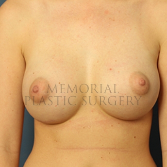 A front view after photo of patient 378 that underwent Breast Augmentation procedures at Memorial Plastic Surgery