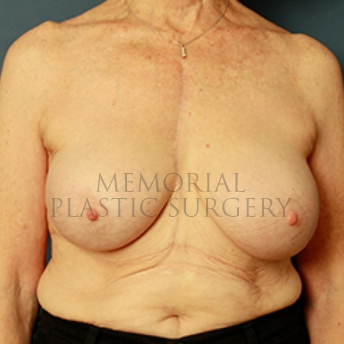 A front view after photo of patient 332 that underwent Breast Augmentation procedures at Memorial Plastic Surgery