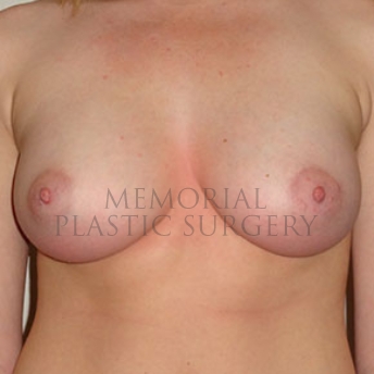 A front view after photo of patient 171 that underwent Breast Augmentation procedures at Memorial Plastic Surgery