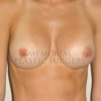 A front view after photo of patient 175 that underwent Breast Augmentation procedures at Memorial Plastic Surgery