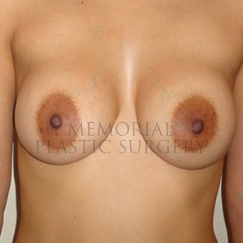 A front view after photo of patient 179 that underwent Breast Augmentation procedures at Memorial Plastic Surgery