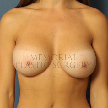 A front view after photo of patient 403 that underwent Breast Augmentation procedures at Memorial Plastic Surgery