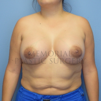 A front view after photo of patient 1257 that underwent Breast Augmentation procedures at Memorial Plastic Surgery