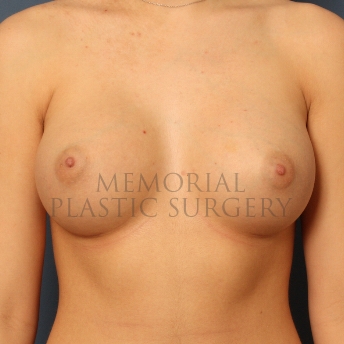 A front view after photo of patient 395 that underwent Breast Augmentation procedures at Memorial Plastic Surgery