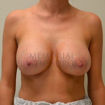 A front view after photo of patient 126 that underwent Breast Augmentation procedures at Memorial Plastic Surgery