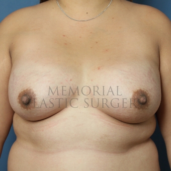 A front view after photo of patient 419 that underwent Breast Augmentation procedures at Memorial Plastic Surgery