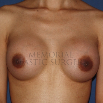 A front view after photo of patient 473 that underwent Breast Augmentation procedures at Memorial Plastic Surgery