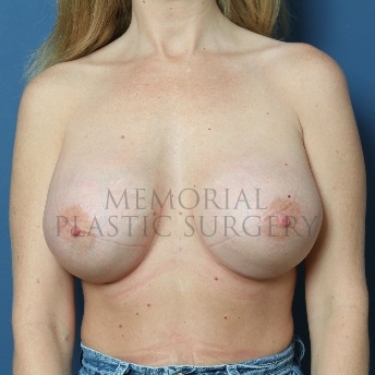 A front view after photo of patient 97 that underwent Breast Augmentation procedures at Memorial Plastic Surgery