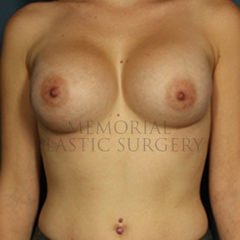 A front view after photo of patient 346 that underwent Breast Augmentation procedures at Memorial Plastic Surgery