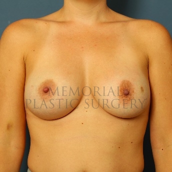 A front view after photo of patient 59 that underwent Breast Augmentation procedures at Memorial Plastic Surgery