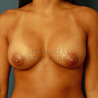 A front view after photo of patient 409 that underwent Breast Augmentation procedures at Memorial Plastic Surgery