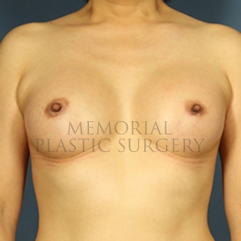 A front view after photo of patient 328 that underwent Breast Augmentation procedures at Memorial Plastic Surgery