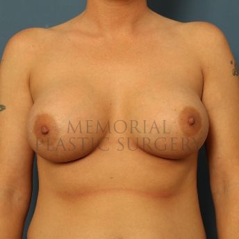 A front view after photo of patient 165 that underwent Breast Augmentation procedures at Memorial Plastic Surgery