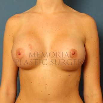 A front view after photo of patient 136 that underwent Breast Augmentation procedures at Memorial Plastic Surgery