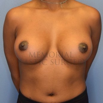 A front view after photo of patient 2412 that underwent Breast Augmentation procedures at Memorial Plastic Surgery