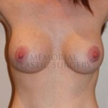 A front view after photo of patient 187 that underwent Breast Augmentation procedures at Memorial Plastic Surgery