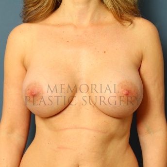 A front view after photo of patient 91 that underwent Breast Augmentation procedures at Memorial Plastic Surgery