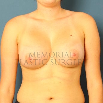 A front view after photo of patient 107 that underwent Breast Augmentation procedures at Memorial Plastic Surgery