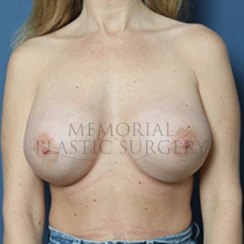 A front view after photo of patient 391 that underwent Breast Augmentation procedures at Memorial Plastic Surgery