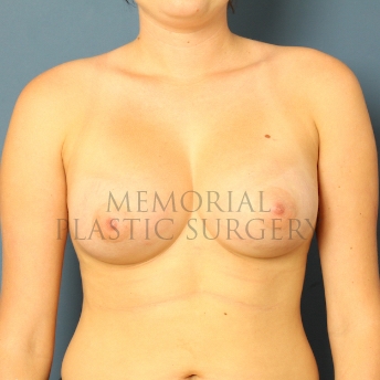A front view after photo of patient 468 that underwent Breast Augmentation procedures at Memorial Plastic Surgery