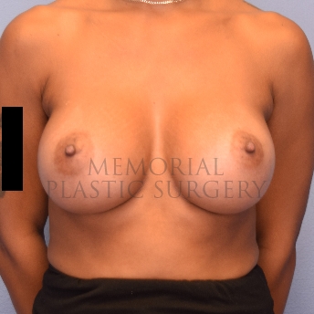 A front view after photo of patient 1072 that underwent Breast Augmentation procedures at Memorial Plastic Surgery