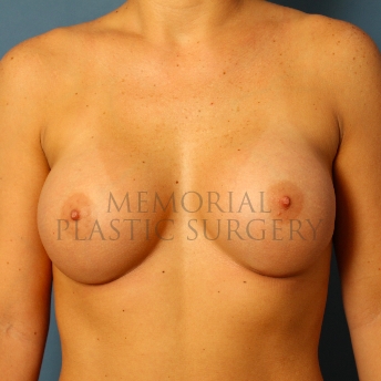 A front view after photo of patient 471 that underwent Breast Augmentation procedures at Memorial Plastic Surgery