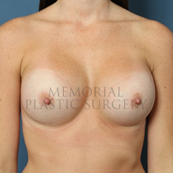 A front view after photo of patient 348 that underwent Breast Augmentation procedures at Memorial Plastic Surgery