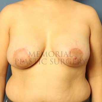 A front view after photo of patient 464 that underwent Breast Augmentation procedures at Memorial Plastic Surgery