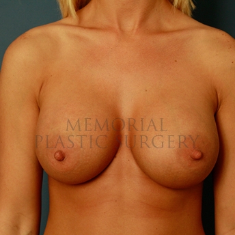 A front view after photo of patient 273 that underwent Breast Augmentation procedures at Memorial Plastic Surgery