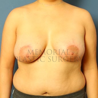 A front view after photo of patient 154 that underwent Breast Augmentation procedures at Memorial Plastic Surgery