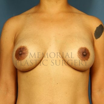 A front view after photo of patient 135 that underwent Breast Augmentation procedures at Memorial Plastic Surgery