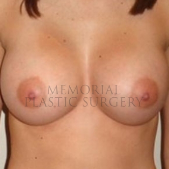 A front view after photo of patient 189 that underwent Breast Augmentation procedures at Memorial Plastic Surgery
