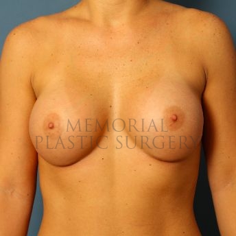 A front view after photo of patient 150 that underwent Breast Augmentation procedures at Memorial Plastic Surgery