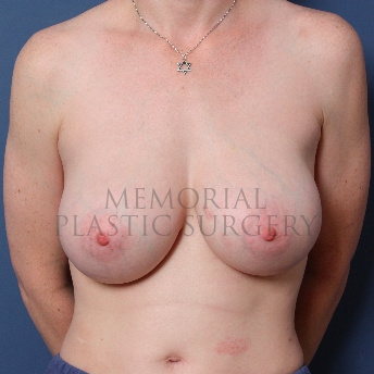A front view after photo of patient 480 that underwent Breast Augmentation procedures at Memorial Plastic Surgery