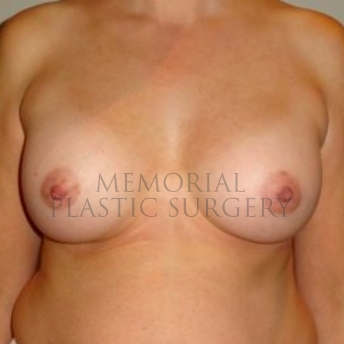A front view after photo of patient 178 that underwent Breast Augmentation procedures at Memorial Plastic Surgery