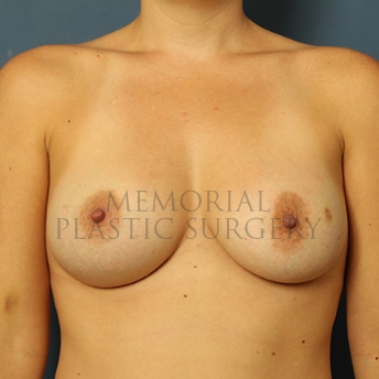 A front view after photo of patient 283 that underwent Breast Augmentation procedures at Memorial Plastic Surgery