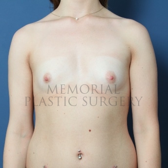A front view before photo of patient 70 that underwent Breast Augmentation procedures at Memorial Plastic Surgery