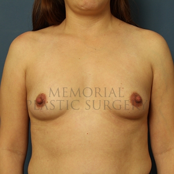 A front view before photo of patient 268 that underwent Breast Augmentation procedures at Memorial Plastic Surgery
