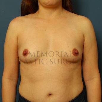 A front view before photo of patient 56 that underwent Breast Augmentation procedures at Memorial Plastic Surgery