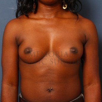 A front view before photo of patient 76 that underwent Breast Augmentation procedures at Memorial Plastic Surgery