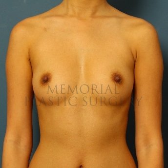 A front view before photo of patient 119 that underwent Breast Augmentation procedures at Memorial Plastic Surgery