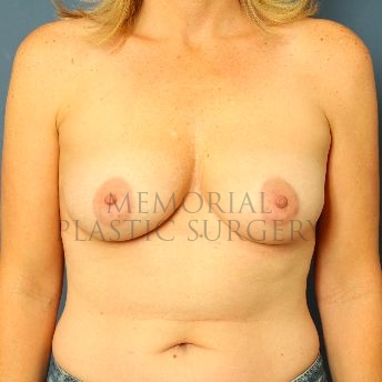 A front view before photo of patient 163 that underwent Breast Augmentation procedures at Memorial Plastic Surgery