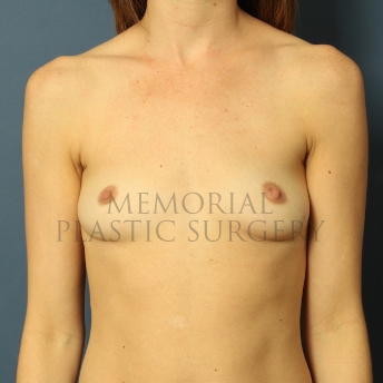 A front view before photo of patient 465 that underwent Breast Augmentation procedures at Memorial Plastic Surgery