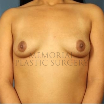 A front view before photo of patient 204 that underwent Breast Augmentation procedures at Memorial Plastic Surgery